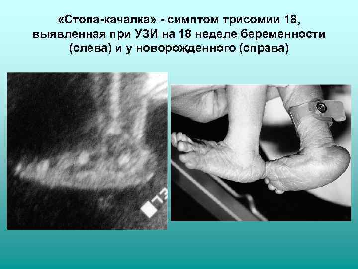   «Стопа-качалка» - симптом трисомии 18, выявленная при УЗИ на 18 неделе беременности