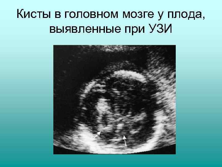 Кисты в головном мозге у плода,  выявленные при УЗИ 