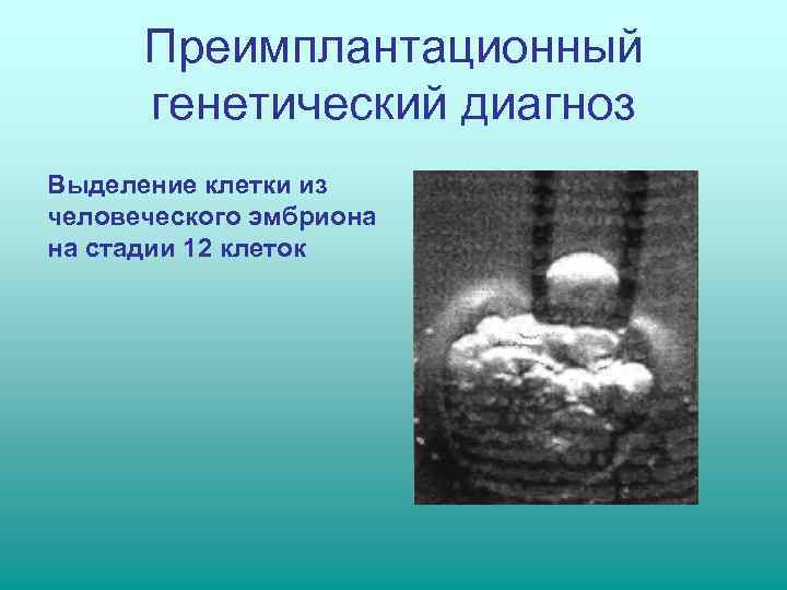  Преимплантационный  генетический диагноз Выделение клетки из человеческого эмбриона на стадии 12 клеток