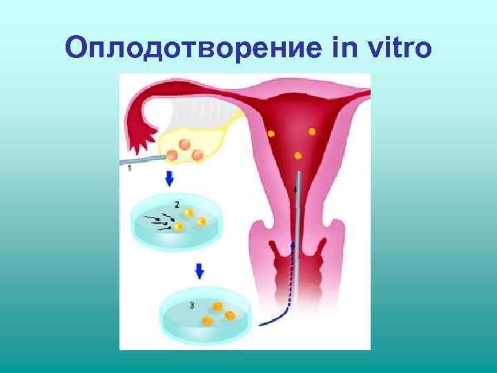 Оплодотворение in vitro 