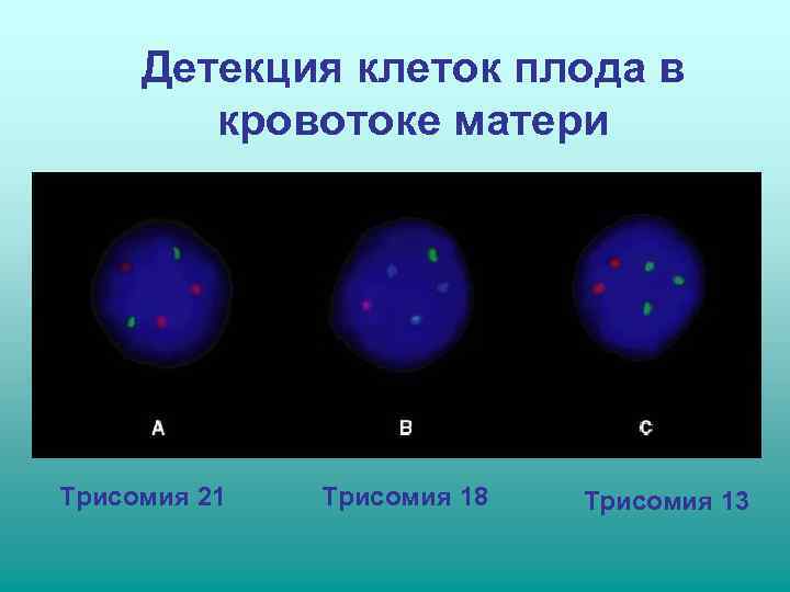  Детекция клеток плода в   кровотоке матери Трисомия 21  Трисомия 18