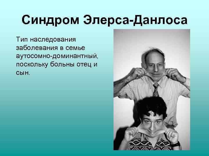  Синдром Элерса-Данлоса Тип наследования заболевания в семье аутосомно-доминантный, поскольку больны отец и сын.