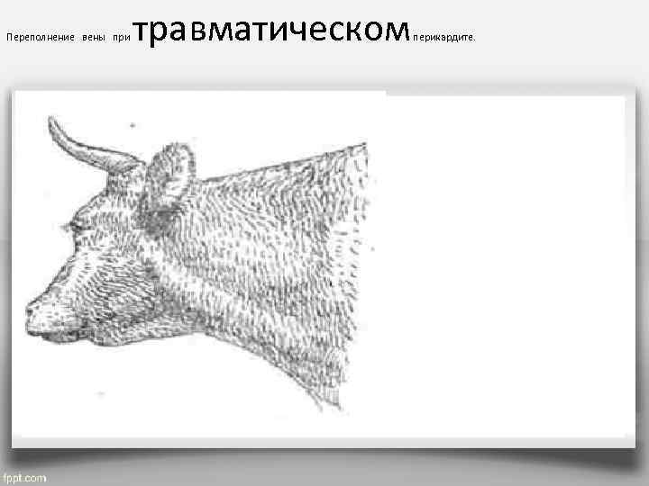 Переполнение  вены  при  травматическом  перикардите. 