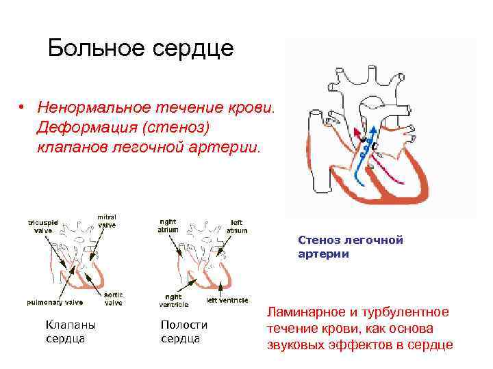   Больное сердце  • Ненормальное течение крови.  Деформация (стеноз)  клапанов