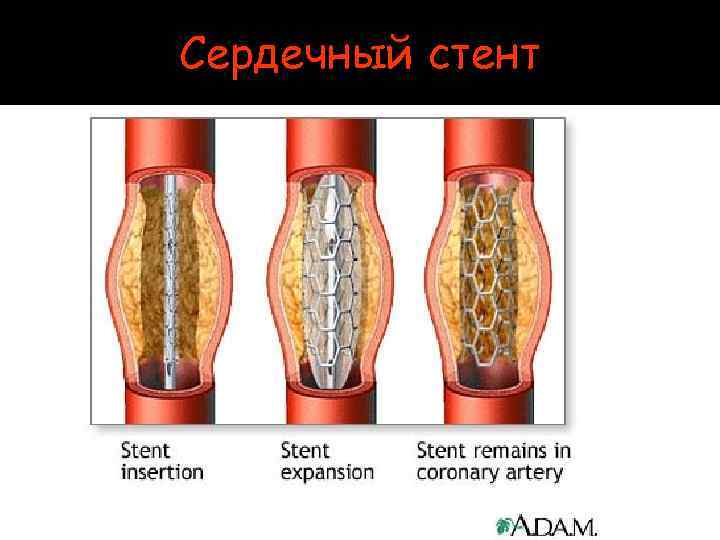 Сердечный стент 