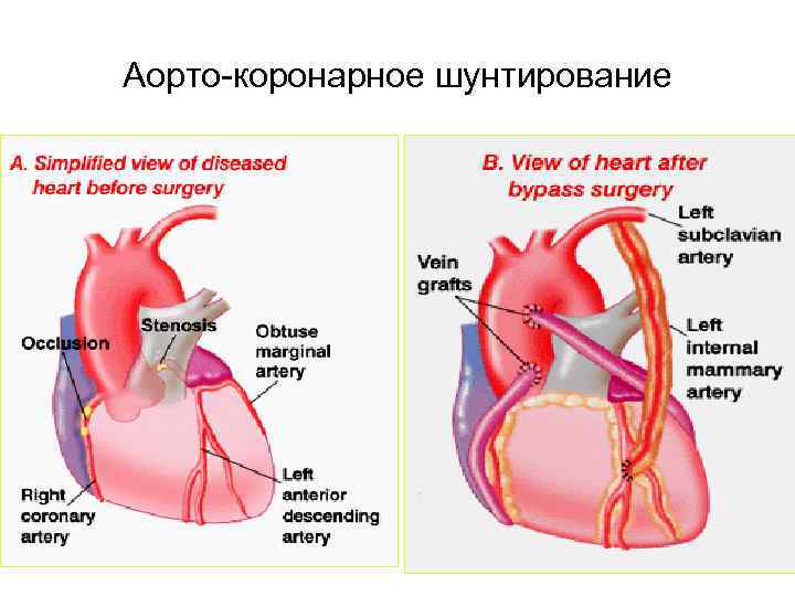 Аорто-коронарное шунтирование 