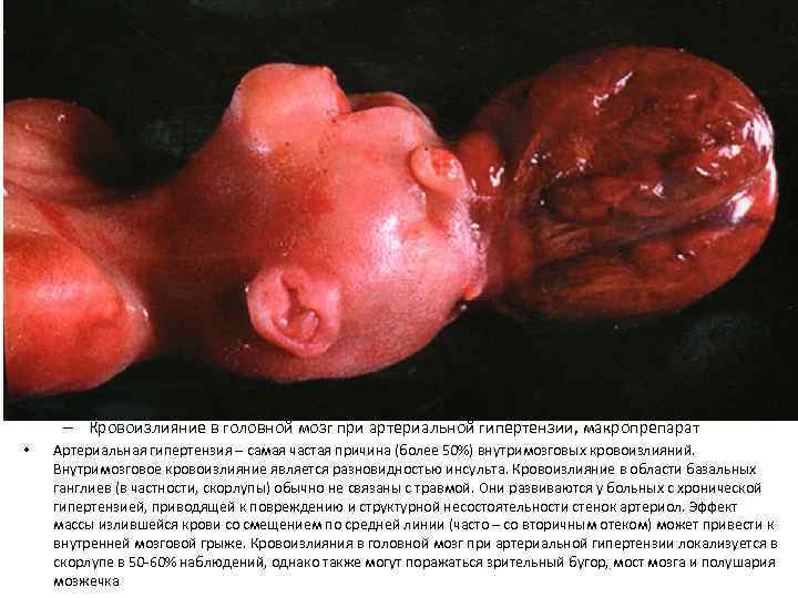 – Кровоизлияние в головной мозг при артериальной гипертензии, макропрепарат •  Артериальная гипертензия