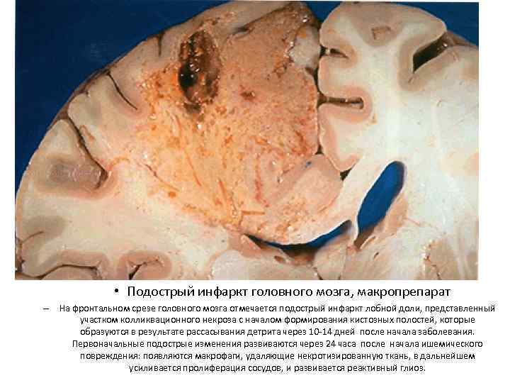     • Подострый инфаркт головного мозга, макропрепарат – На фронтальном срезе