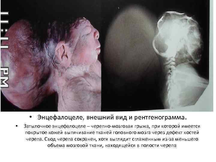   • Энцефалоцеле, внешний вид и рентгенограмма.  •  Затылочное энцефалоцеле –