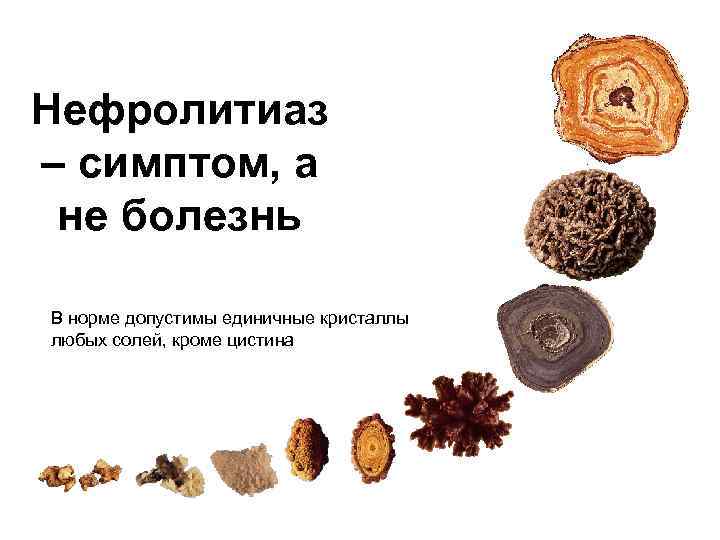 Нефролитиаз – симптом, а  не болезнь В норме допустимы единичные кристаллы любых солей,
