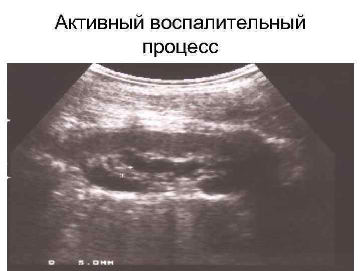 Активный воспалительный   процесс 