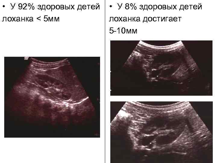  • У 92% здоровых детей  • У 8% здоровых детей лоханка <