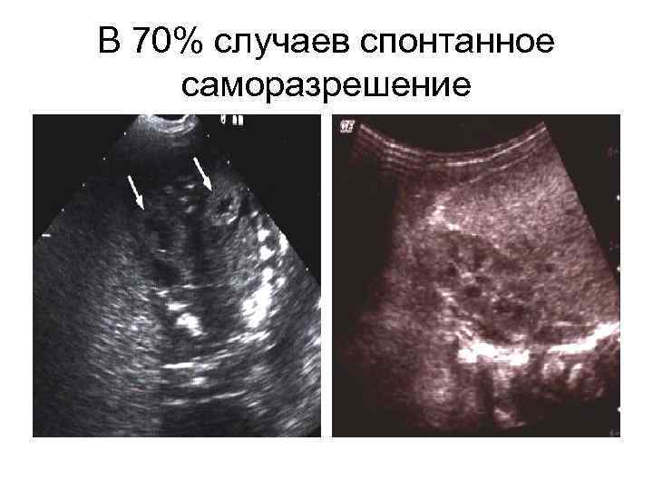 В 70% случаев спонтанное саморазрешение 