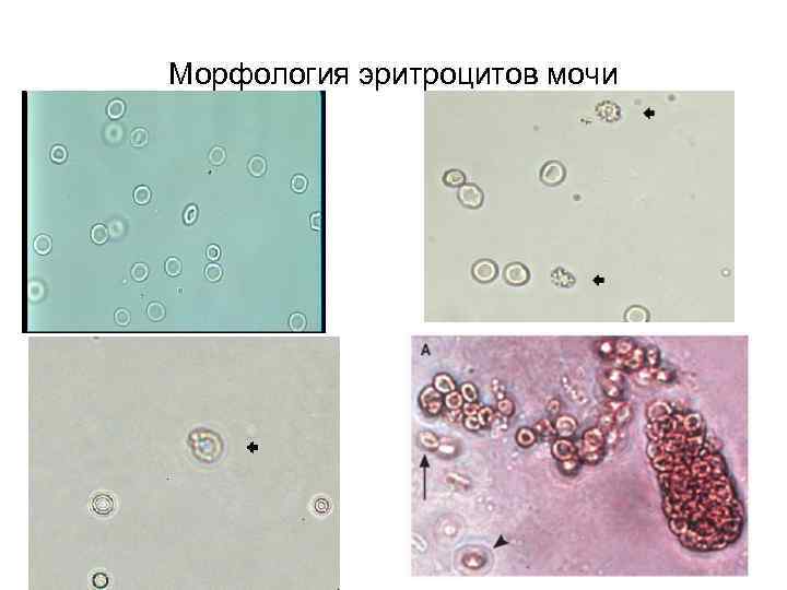 Появление эритроцитов в моче. Измененные эритроциты в моче микроскопия. Эритроциты в моче микроскопия. Выщелоченные эритроциты в моче под микроскопом. Морфология эритроцитов в моче измененные.