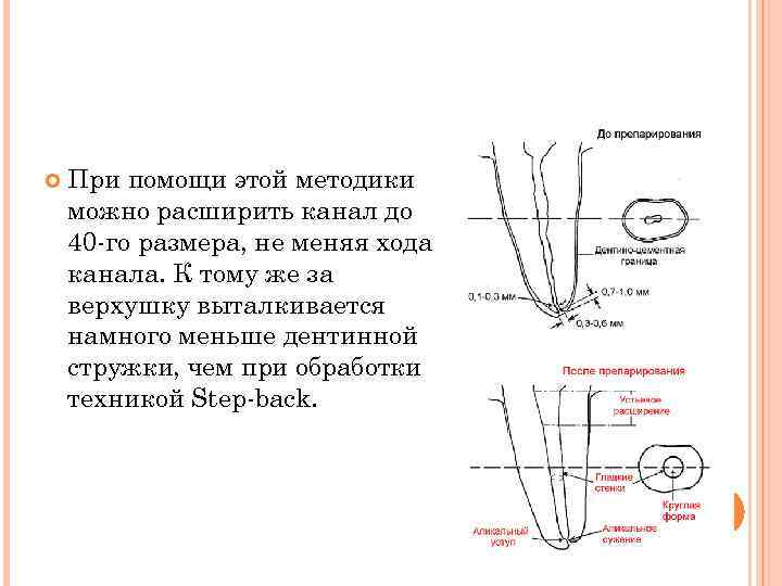   При помощи этой методики можно расширить канал до 40 -го размера, не