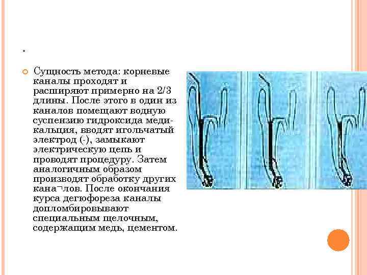 . Сущность метода: корневые каналы проходят и расширяют примерно на 2/3 длины. После этого