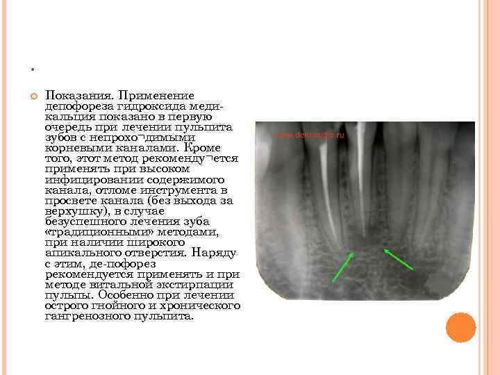 . Показания. Применение депофореза гидроксида меди- кальция показано в первую очередь при лечении пульпита