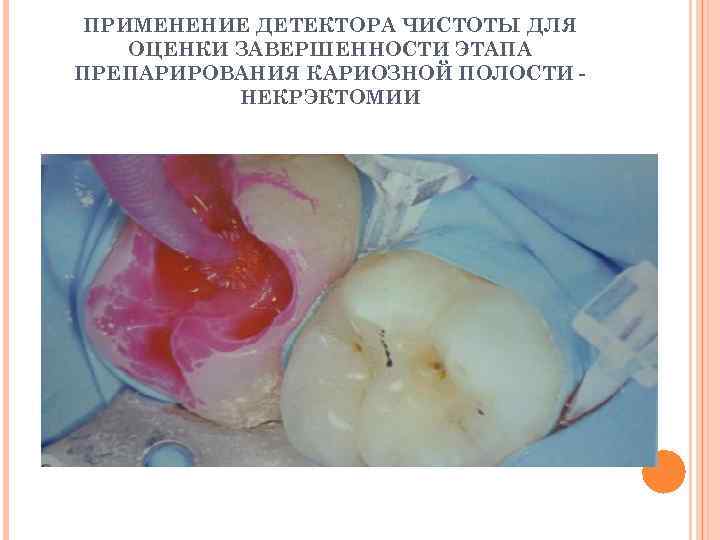  ПРИМЕНЕНИЕ ДЕТЕКТОРА ЧИСТОТЫ ДЛЯ ОЦЕНКИ ЗАВЕРШЕННОСТИ ЭТАПА ПРЕПАРИРОВАНИЯ КАРИОЗНОЙ ПОЛОСТИ -  НЕКРЭКТОМИИ
