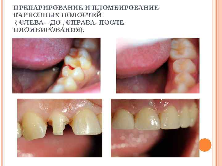 ПРЕПАРИРОВАНИЕ И ПЛОМБИРОВАНИЕ КАРИОЗНЫХ ПОЛОСТЕЙ ( СЛЕВА – ДО-, СПРАВА- ПОСЛЕ ПЛОМБИРОВАНИЯ). 