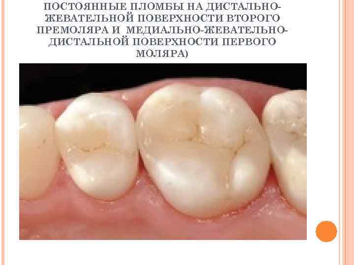  ПОСТОЯННЫЕ ПЛОМБЫ НА ДИСТАЛЬНО- ЖЕВАТЕЛЬНОЙ ПОВЕРХНОСТИ ВТОРОГО ПРЕМОЛЯРА И МЕДИАЛЬНО-ЖЕВАТЕЛЬНО-  ДИСТАЛЬНОЙ ПОВЕРХНОСТИ
