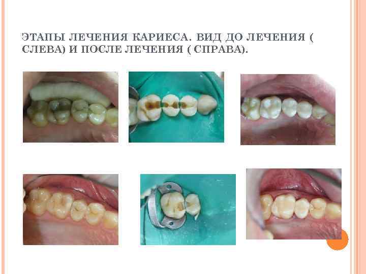 ЭТАПЫ ЛЕЧЕНИЯ КАРИЕСА. ВИД ДО ЛЕЧЕНИЯ ( СЛЕВА) И ПОСЛЕ ЛЕЧЕНИЯ ( СПРАВА). 