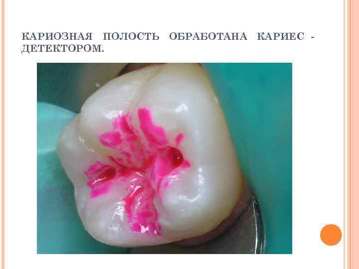 КАРИОЗНАЯ ПОЛОСТЬ ОБРАБОТАНА КАРИЕС - ДЕТЕКТОРОМ. 