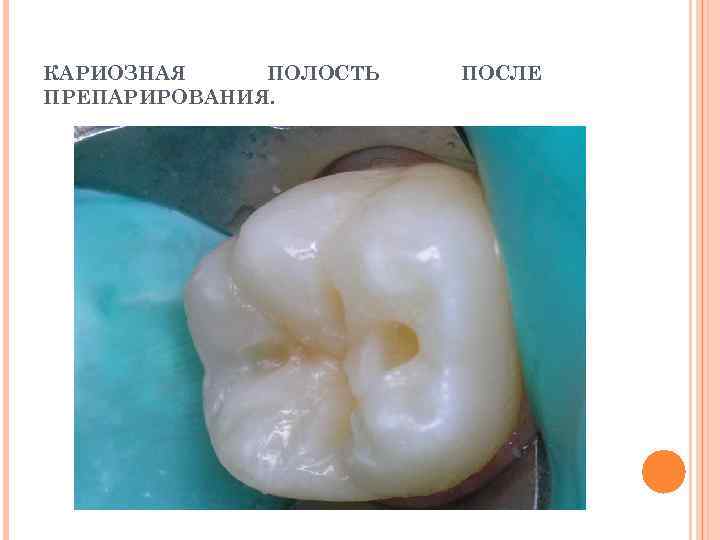 КАРИОЗНАЯ ПОЛОСТЬ  ПОСЛЕ ПРЕПАРИРОВАНИЯ. 