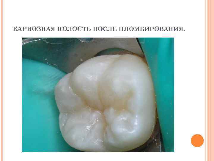 КАРИОЗНАЯ ПОЛОСТЬ ПОСЛЕ ПЛОМБИРОВАНИЯ. 