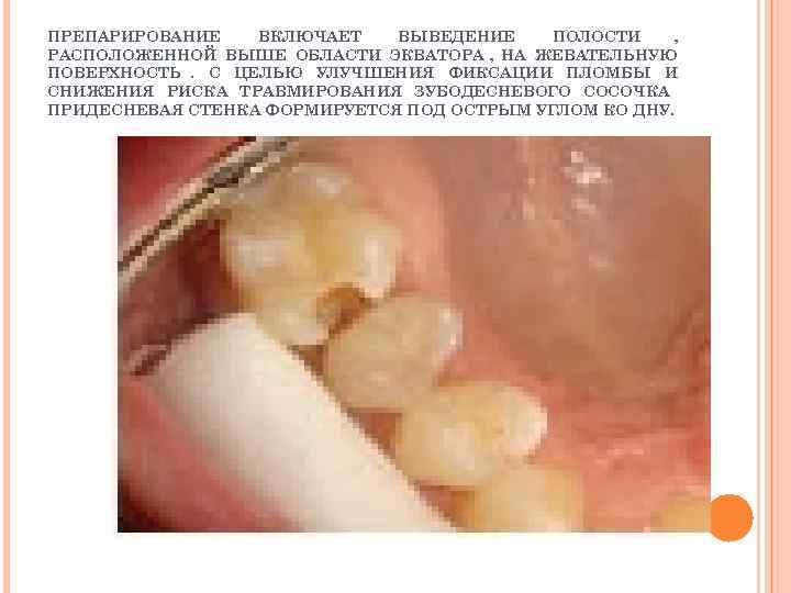 ПРЕПАРИРОВАНИЕ  ВКЛЮЧАЕТ  ВЫВЕДЕНИЕ ПОЛОСТИ  , РАСПОЛОЖЕННОЙ ВЫШЕ ОБЛАСТИ ЭКВАТОРА , НА