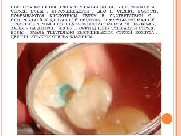 ПОСЛЕ ЗАВЕРШЕНИЯ ПРЕПАРИРОВАНИЯ ПОЛОСТЬ ПРОМЫВАЕТСЯ СТРУЕЙ ВОДЫ , ПРОСУШИВАЕТСЯ. ДНО И СТЕНКИ ПОЛОСТИ ПОКРЫВАЮТСЯ