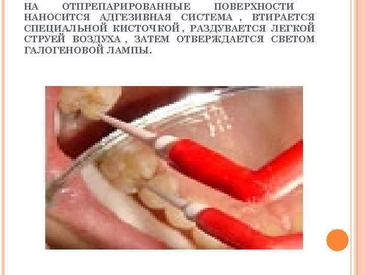 НА  ОТПРЕПАРИРОВАННЫЕ ПОВЕРХНОСТИ НАНОСИТСЯ АДГЕЗИВНАЯ СИСТЕМА , ВТИРАЕТСЯ СПЕЦИАЛЬНОЙ КИСТОЧКОЙ , РАЗДУВАЕТСЯ ЛЕГКОЙ