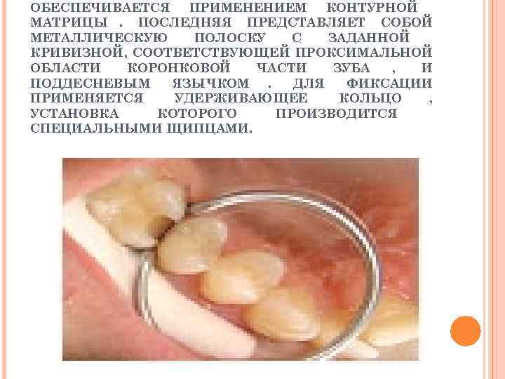 ОБЕСПЕЧИВАЕТСЯ ПРИМЕНЕНИЕМ КОНТУРНОЙ МАТРИЦЫ. ПОСЛЕДНЯЯ ПРЕДСТАВЛЯЕТ СОБОЙ МЕТАЛЛИЧЕСКУЮ  ПОЛОСКУ  С  ЗАДАННОЙ
