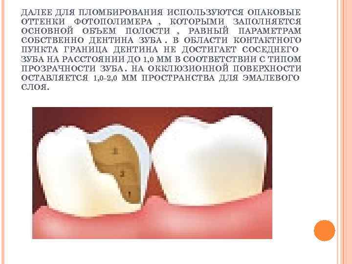 ДАЛЕЕ ДЛЯ ПЛОМБИРОВАНИЯ ИСПОЛЬЗУЮТСЯ ОПАКОВЫЕ ОТТЕНКИ ФОТОПОЛИМЕРА , КОТОРЫМИ ЗАПОЛНЯЕТСЯ ОСНОВНОЙ ОБЪЕМ ПОЛОСТИ ,