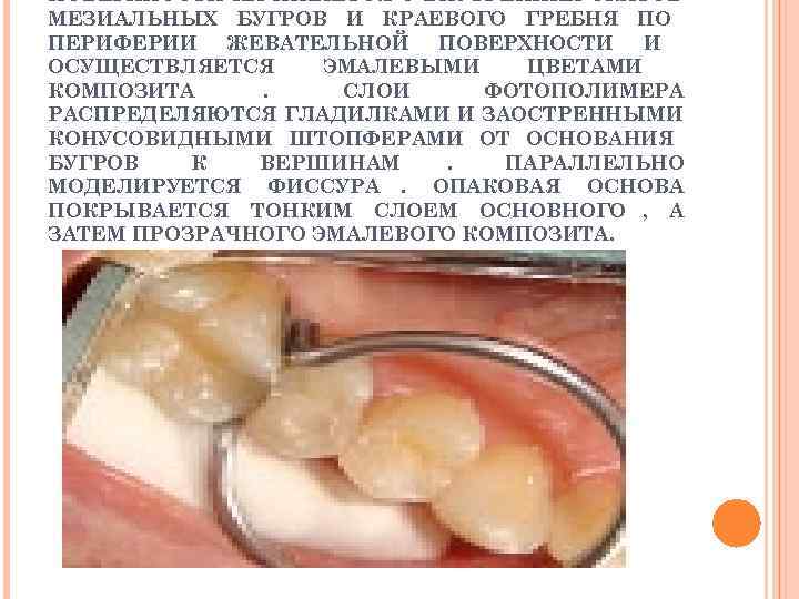 ПОВЕРХНОСТИ НАЧИНАЕТСЯ С ВНУТРЕННИХ СКАТОВ МЕЗИАЛЬНЫХ БУГРОВ И КРАЕВОГО ГРЕБНЯ ПО ПЕРИФЕРИИ ЖЕВАТЕЛЬНОЙ ПОВЕРХНОСТИ