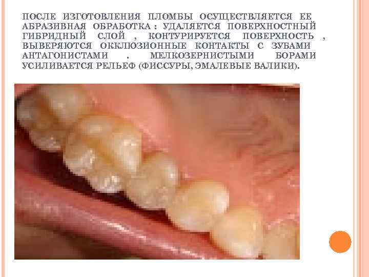 ПОСЛЕ ИЗГОТОВЛЕНИЯ ПЛОМБЫ ОСУЩЕСТВЛЯЕТСЯ ЕЕ АБРАЗИВНАЯ ОБРАБОТКА : УДАЛЯЕТСЯ ПОВЕРХНОСТНЫЙ ГИБРИДНЫЙ СЛОЙ , КОНТУРИРУЕТСЯ