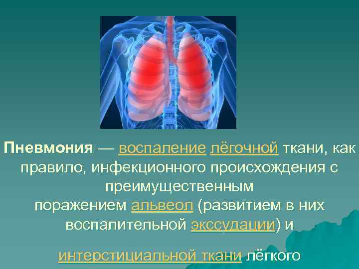 Пневмония — воспаление лёгочной ткани, как  правило, инфекционного происхождения с   