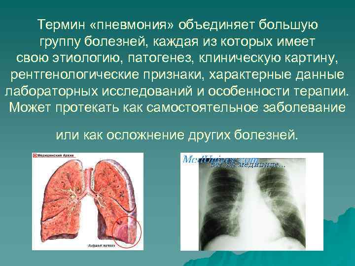 Термин «пневмония» объединяет большую  группу болезней, каждая из которых имеет  свою