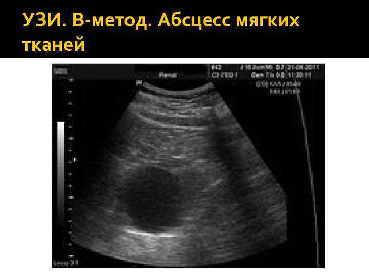УЗИ. В-метод. Абсцесс мягких тканей 