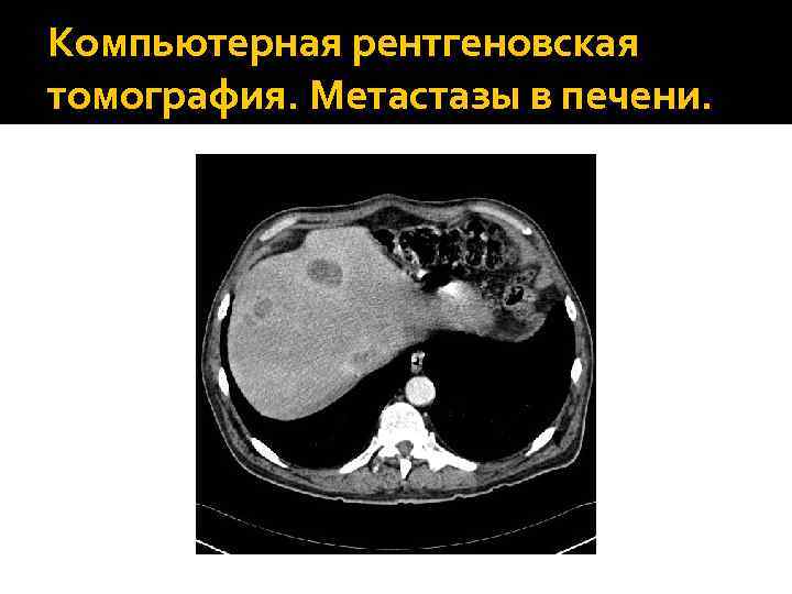 Компьютерная томография показывает метастазы