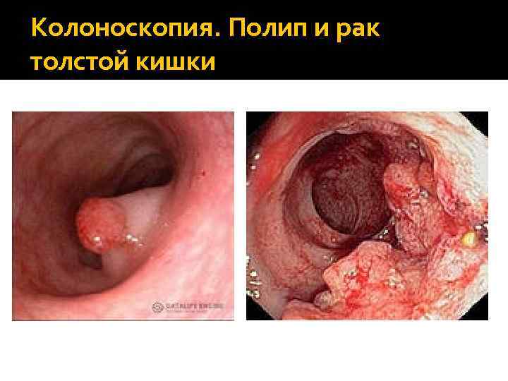Колоноскопия. Полип и рак толстой кишки 