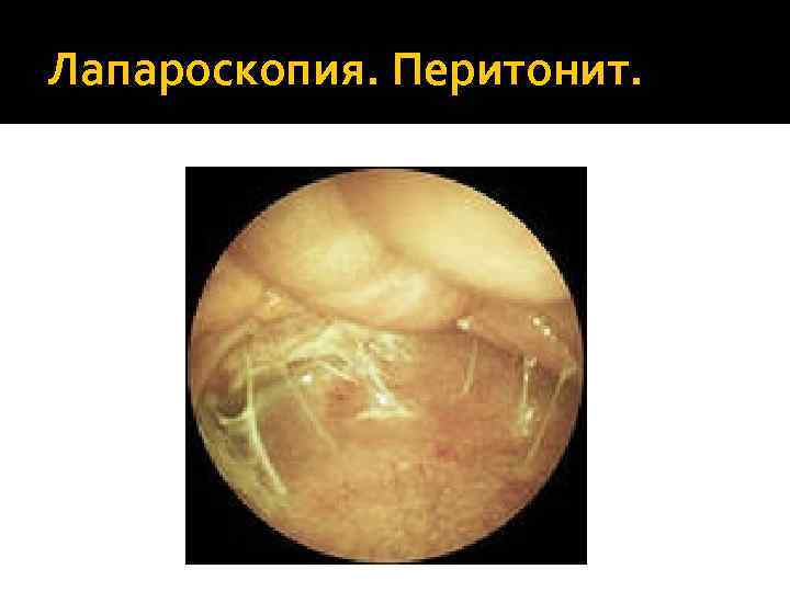 Лапароскопия. Перитонит. 