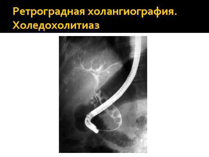 Холедохолитиаз факультетская хирургия презентация