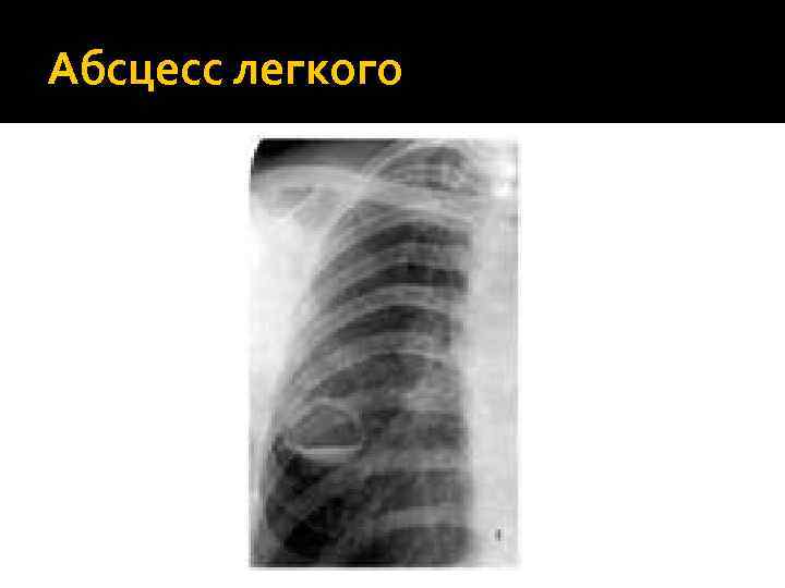 Абсцесс легкого 