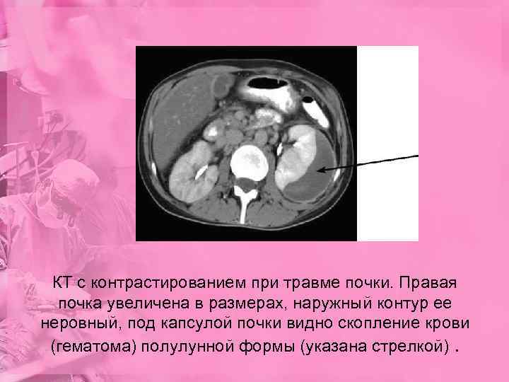  КТ с контрастированием при травме почки. Правая  почка увеличена в размерах, наружный