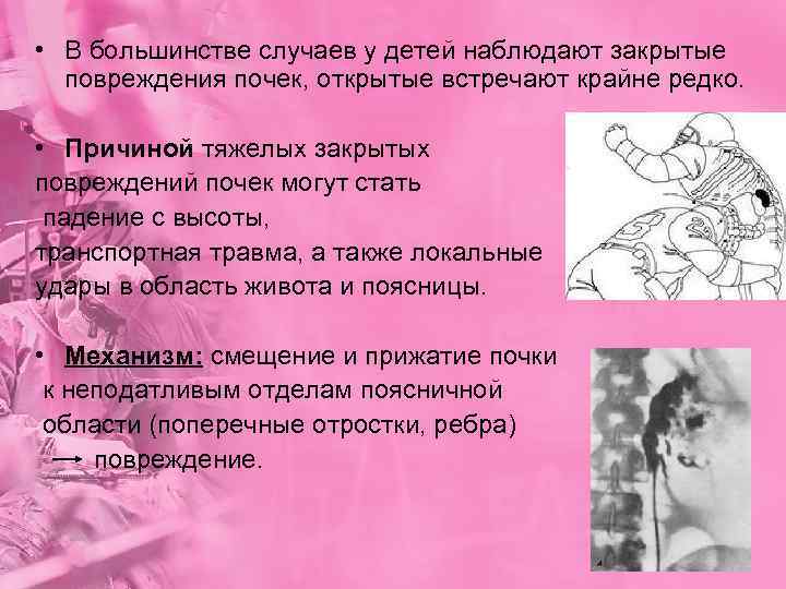  • В большинстве случаев у детей наблюдают закрытые  повреждения почек, открытые встречают