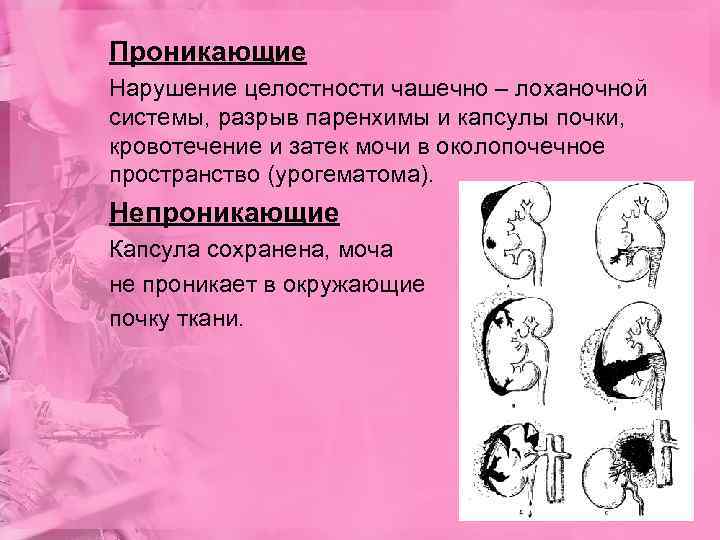 Проникающие Нарушение целостности чашечно – лоханочной системы, разрыв паренхимы и капсулы почки, кровотечение и
