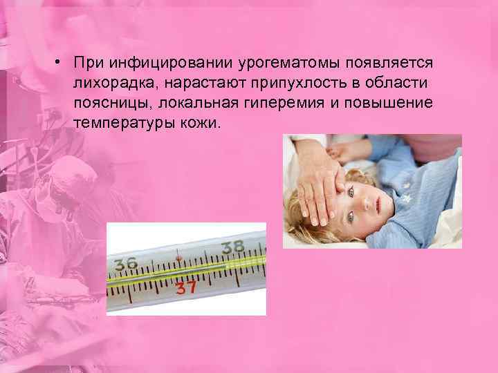  • При инфицировании урогематомы появляется  лихорадка, нарастают припухлость в области  поясницы,