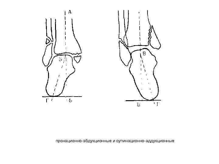 пронационно-абдукционные и супинационно-аддукционные 