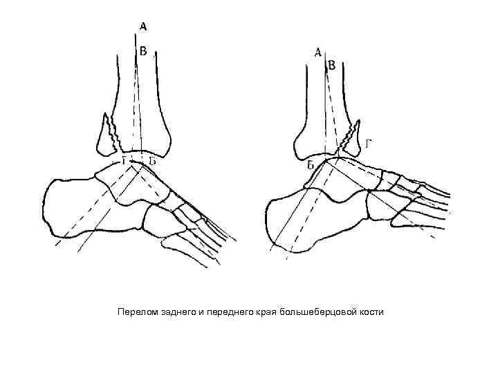 Перелом наружной лодыжки рисунок