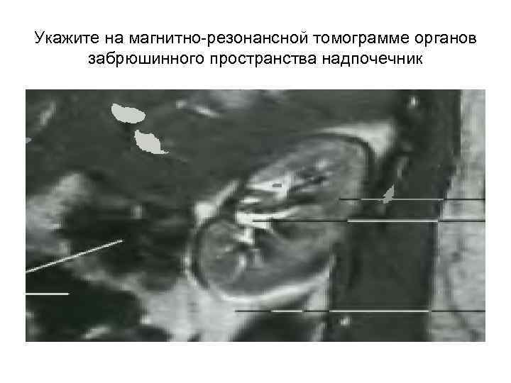Укажите на магнитно-резонансной томограмме органов  забрюшинного пространства надпочечник 